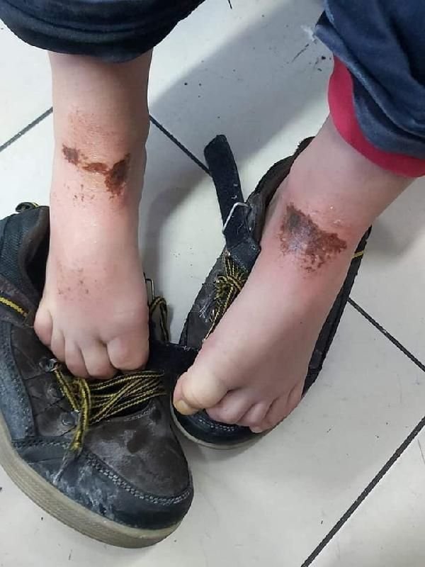 Kar topu oynayan öğrencilerin vücutlarında yanık oluştu