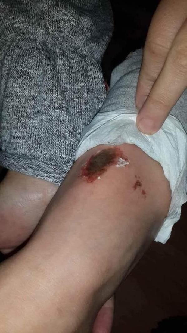 Kar topu oynayan öğrencilerin vücutlarında yanık oluştu