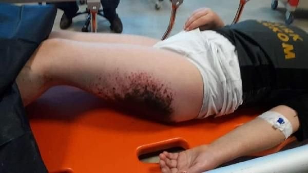 Kar topu oynayan öğrencilerin vücutlarında yanık oluştu